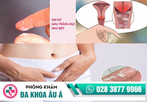 Khí hư ra nhiều như bã đậu là bệnh gì?